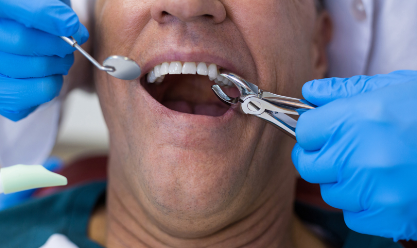 Immediate Tooth Extraction Aftercare