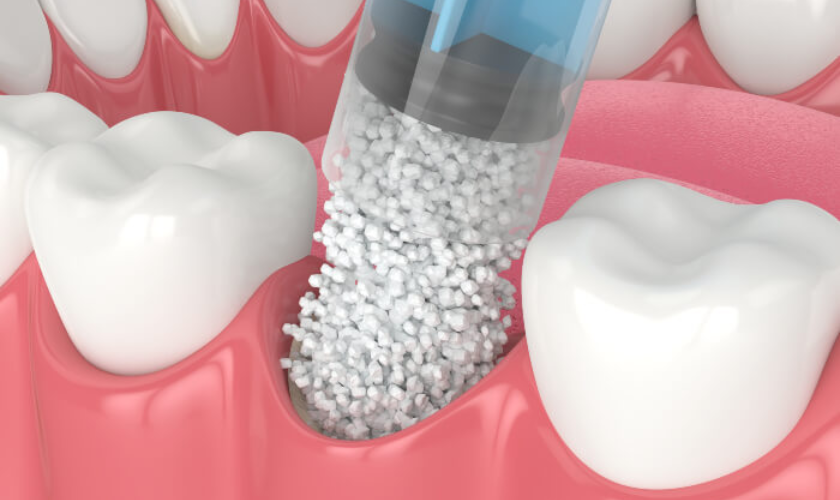 The Bone Grafting Procedure