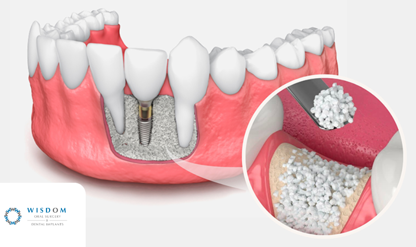 Understanding Bone Grafting