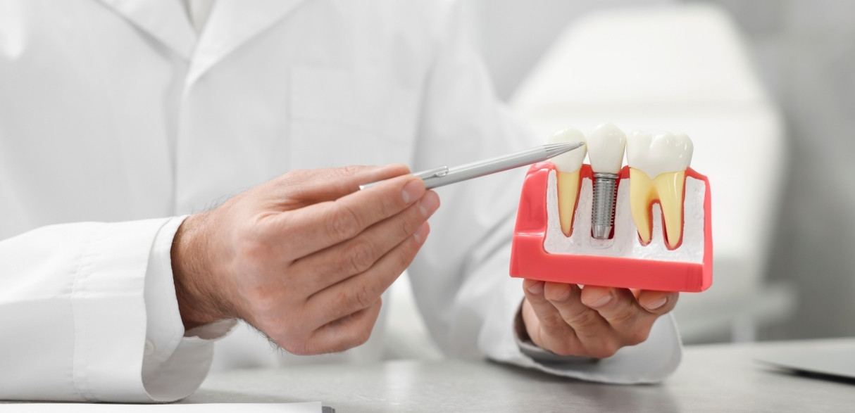 are dental implants safe