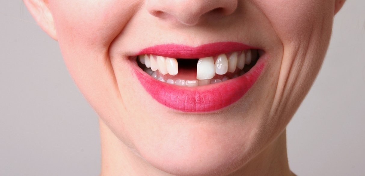 major 5 options when it comes to replacing missing teeth