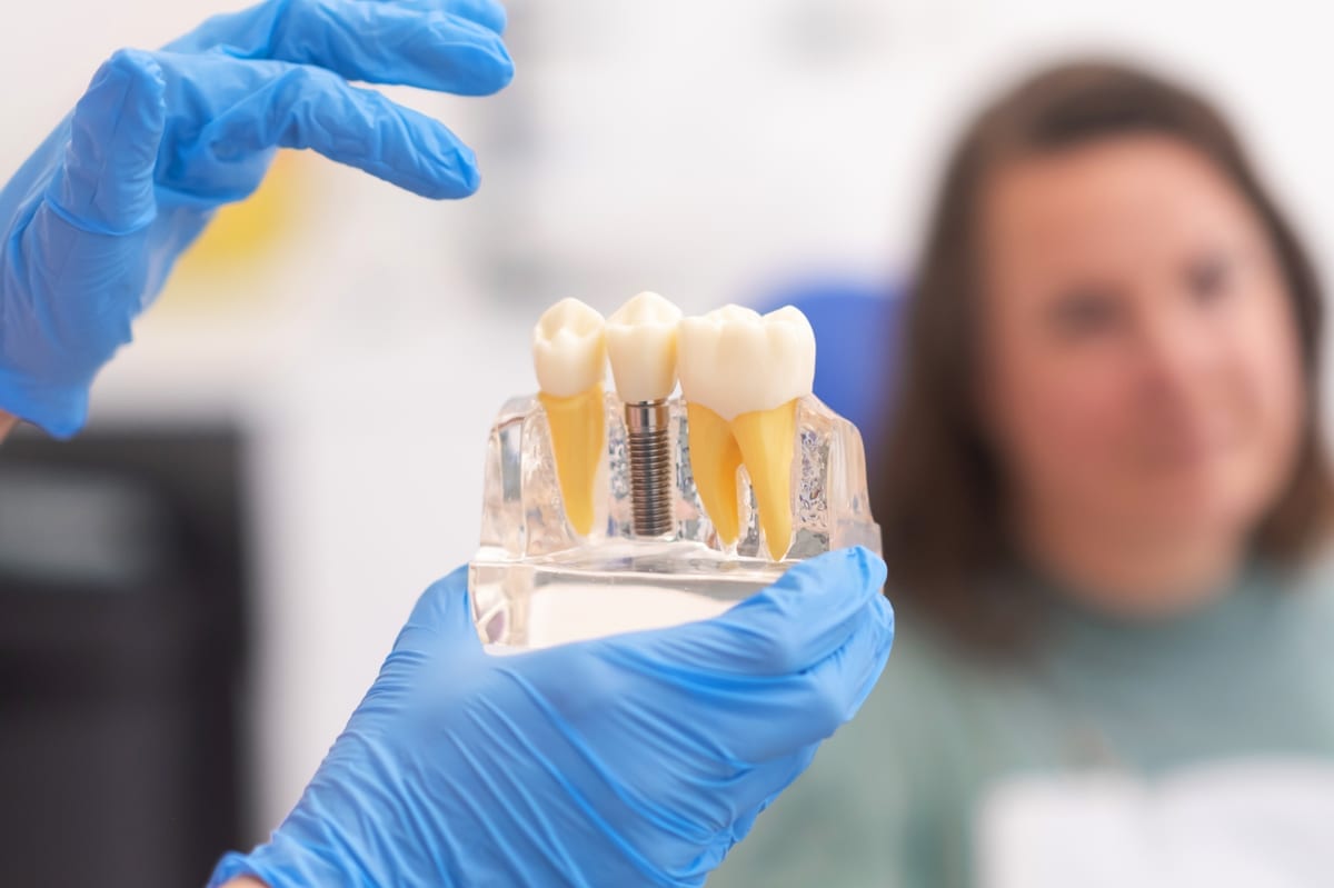 Dental Implants in San Jose