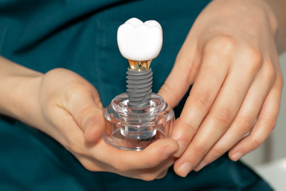 Dental Implants in San Jose